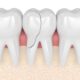 Can a Cracked Tooth Be Saved, or Does It Have to Come Out?