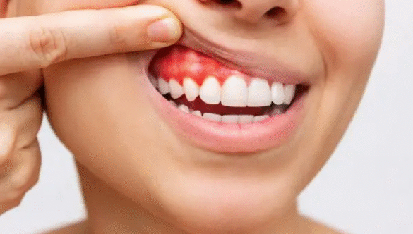 What Is Gum Disease and Why Does It Get Worse Without You Realising?
