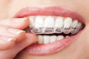 Is Invisalign Right for Me? A Dentist’s Guide to Who It Works For — and Who It Does Not