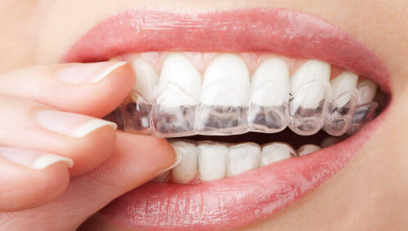 Is Invisalign Right for Me? A Dentist’s Guide to Who It Works For — and Who It Does Not