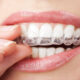 Is Invisalign Right for Me? A Dentist’s Guide to Who It Works For — and Who It Does Not
