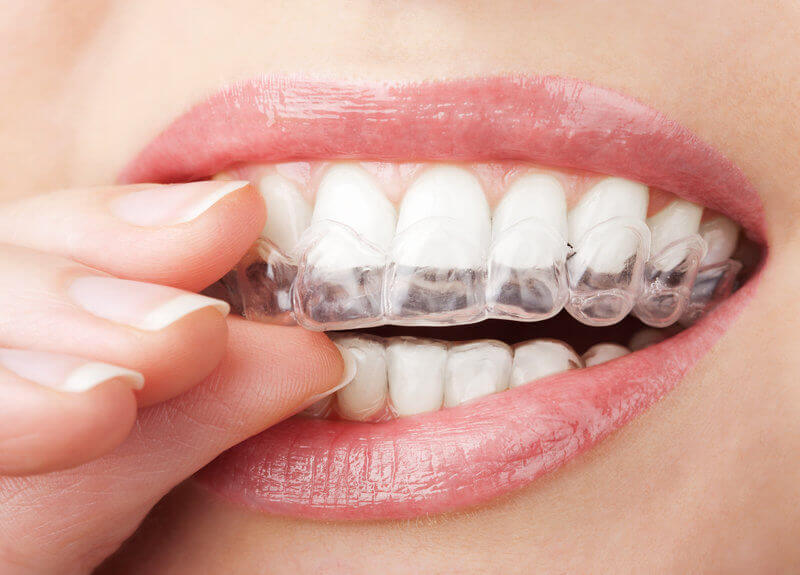 Is Invisalign Right for Me? A Dentist’s Guide to Who It Works For — and Who It Does Not