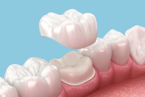 Will My Dental Crown Look Natural? Aesthetics, Materials and What to Expect