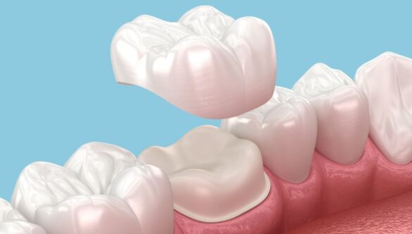 Will My Dental Crown Look Natural? Aesthetics, Materials and What to Expect
