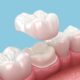 Will My Dental Crown Look Natural? Aesthetics, Materials and What to Expect