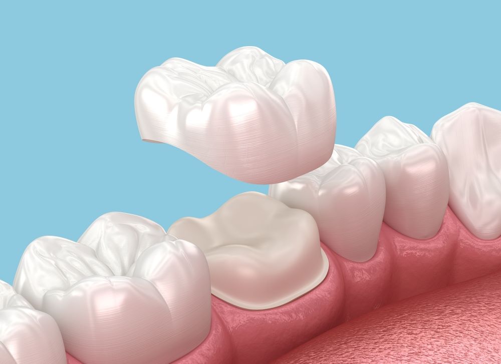Will My Dental Crown Look Natural? Aesthetics, Materials and What to Expect