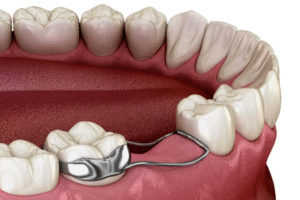 Space Maintainers for Children: What They Are and Why Early Tooth Loss Matters