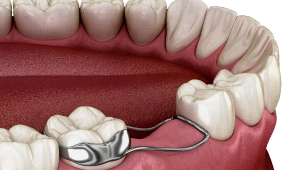 Space Maintainers for Children: What They Are and Why Early Tooth Loss Matters