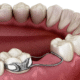 Space Maintainers for Children: What They Are and Why Early Tooth Loss Matters