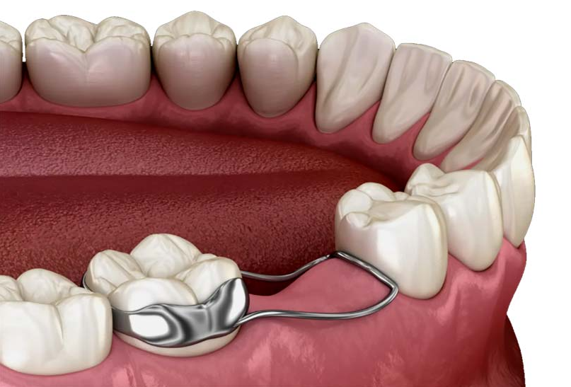 Space Maintainers for Children: What They Are and Why Early Tooth Loss Matters