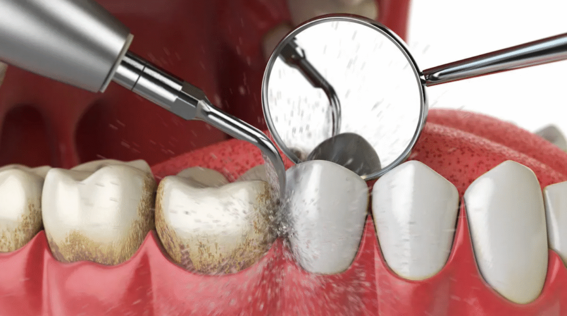 Teeth Cleaning in Gandhinagar: What a Professional Clean Actually Does That Brushing Cannot