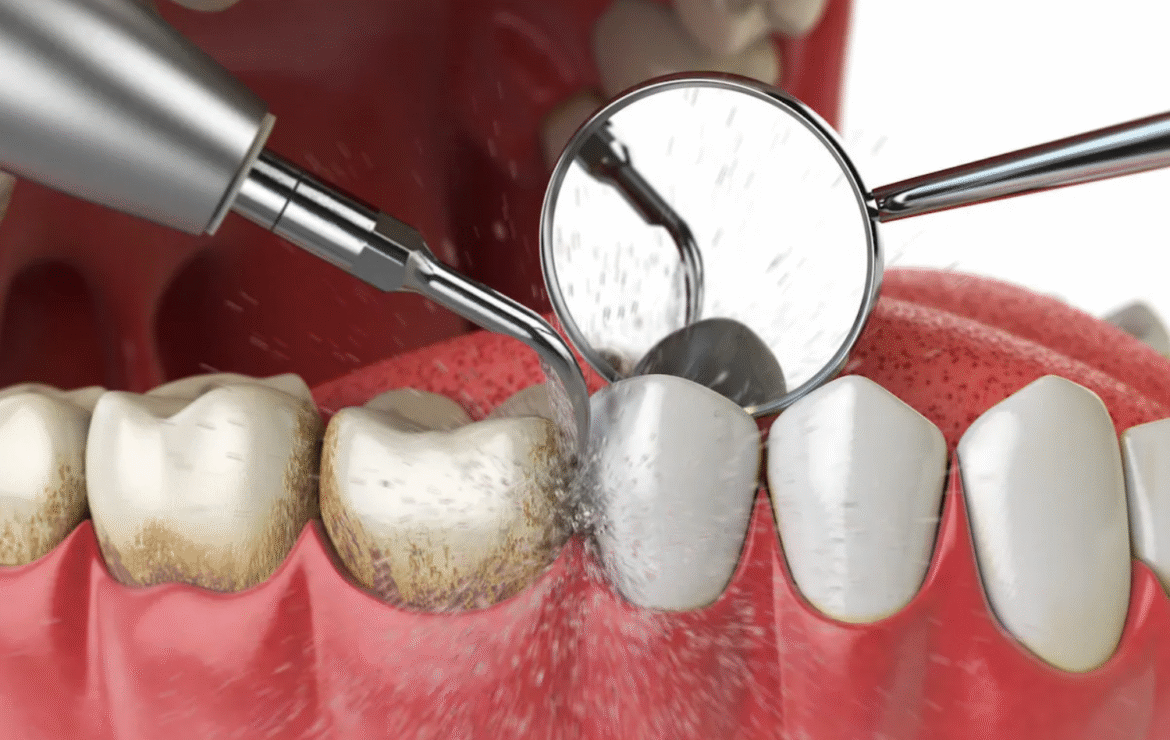 Teeth Cleaning in Gandhinagar: What a Professional Clean Actually Does That Brushing Cannot