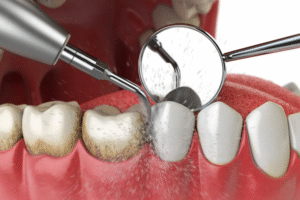 Teeth Cleaning in Gandhinagar: What a Professional Clean Actually Does That Brushing Cannot