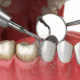 Teeth Cleaning in Gandhinagar: What a Professional Clean Actually Does That Brushing Cannot