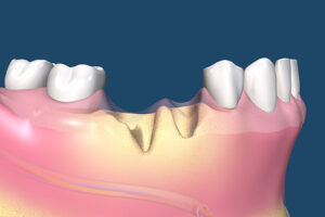 What Happens to Your Jawbone When You Lose a Tooth — and Why Timing Matters