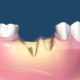 What Happens to Your Jawbone When You Lose a Tooth — and Why Timing Matters