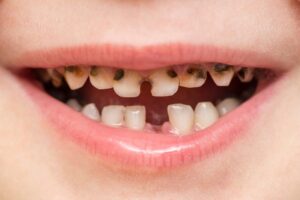 Cavities in Children: How to Spot Them Early and Stop Them Getting Worse