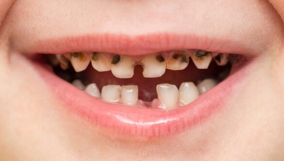 Cavities in Children: How to Spot Them Early and Stop Them Getting Worse