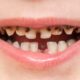 Cavities in Children: How to Spot Them Early and Stop Them Getting Worse