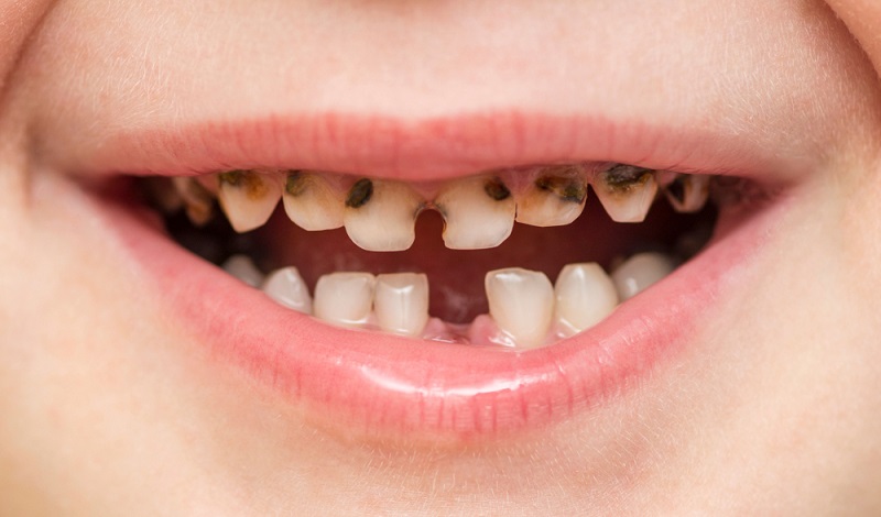 Cavities in Children: How to Spot Them Early and Stop Them Getting Worse