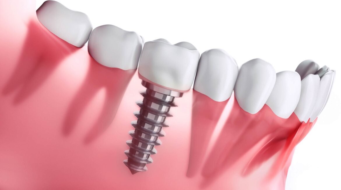 Dental Implants in Gandhinagar: A Complete Guide for Patients Considering Treatment