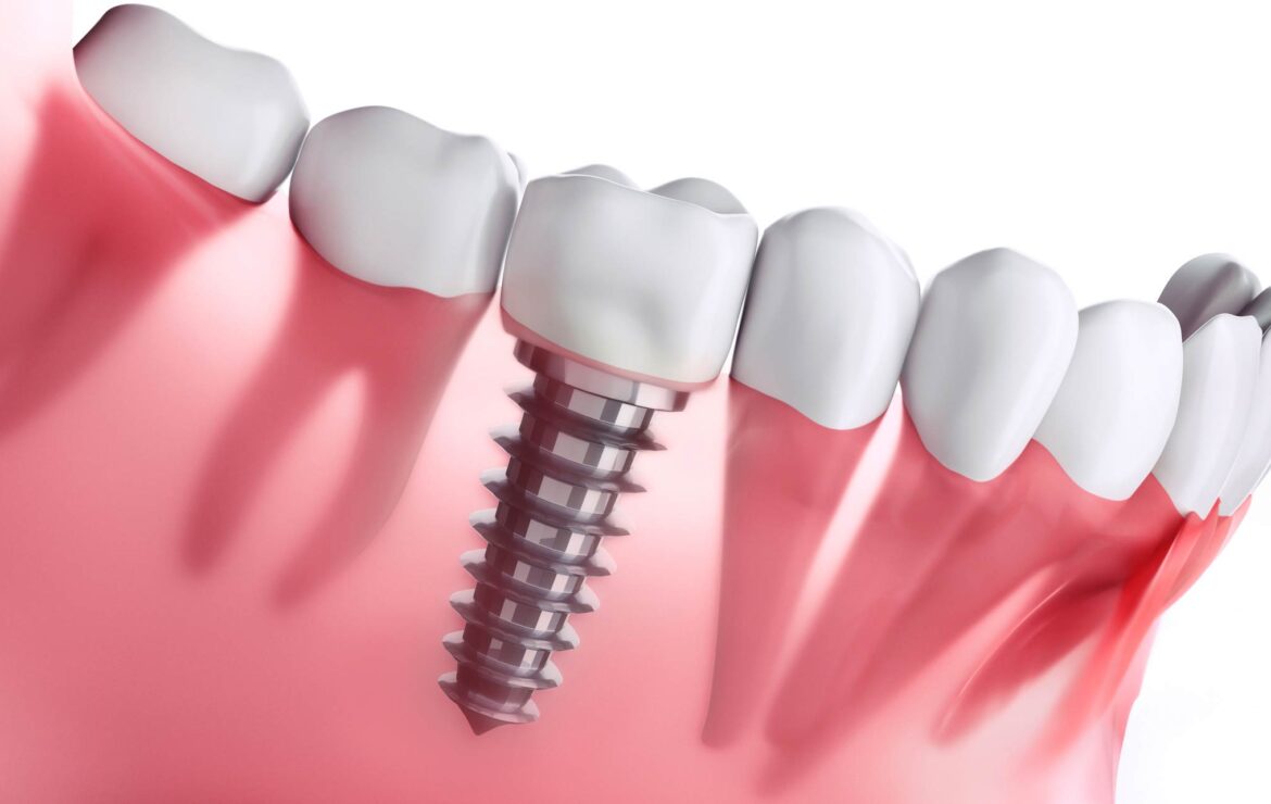 Dental Implants in Gandhinagar: A Complete Guide for Patients Considering Treatment