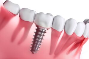 Dental Implants in Gandhinagar: A Complete Guide for Patients Considering Treatment