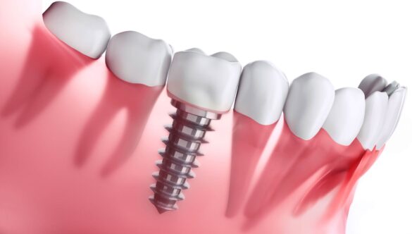 Dental Implants in Gandhinagar: A Complete Guide for Patients Considering Treatment