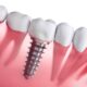 Dental Implants in Gandhinagar: A Complete Guide for Patients Considering Treatment