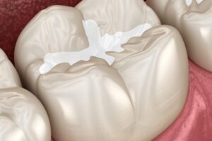 Fissure Sealants for Children: What They Are, When to Get Them, and Why They Matter