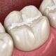 Fissure Sealants for Children: What They Are, When to Get Them, and Why They Matter