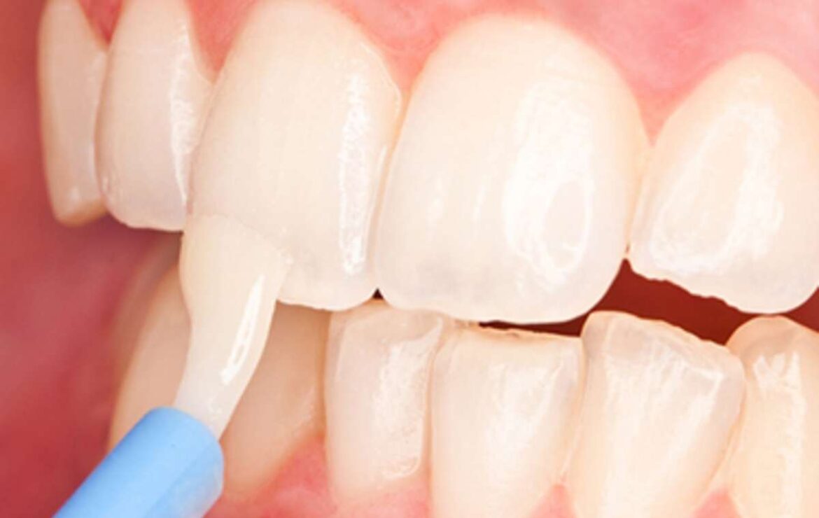 Fluoride Treatments for Children: Do They Really Help and Are They Safe?