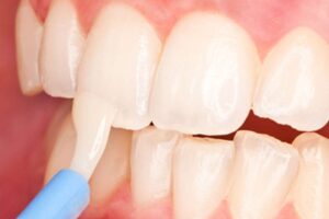 Fluoride Treatments for Children: Do They Really Help and Are They Safe?