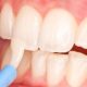 Fluoride Treatments for Children: Do They Really Help and Are They Safe?