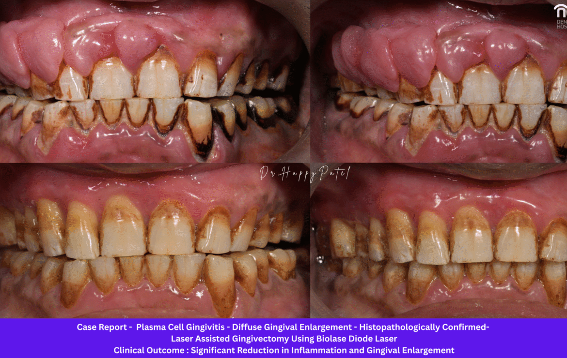 Plasma Cell Gingivitis: Causes, Symptoms, Diagnosis, and Advanced Diode Laser Treatment at Nova Dental Hospital, Gandhinagar