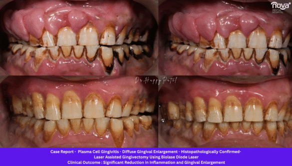 Plasma Cell Gingivitis: Causes, Symptoms, Diagnosis, and Advanced Diode Laser Treatment at Nova Dental Hospital, Gandhinagar