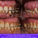 Plasma Cell Gingivitis: Causes, Symptoms, Diagnosis, and Advanced Diode Laser Treatment at Nova Dental Hospital, Gandhinagar