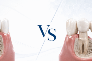 Dental implant vs dental bridge comparison for replacing one missing tooth
