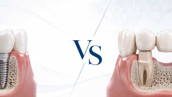 Dental implant vs dental bridge comparison for replacing one missing tooth