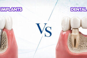 Dental Implants for a Single Missing Tooth: Is It Really Better Than a Bridge?