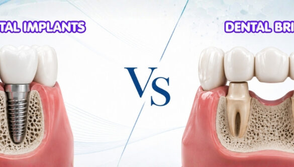 Dental Implants for a Single Missing Tooth: Is It Really Better Than a Bridge?