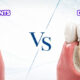 Dental Implants for a Single Missing Tooth: Is It Really Better Than a Bridge?