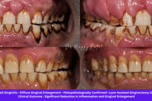 Plasma Cell Gingivitis: Causes, Symptoms, Diagnosis, and Advanced Diode Laser Treatment at Nova Dental Hospital, Gandhinagar