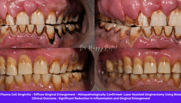 Plasma Cell Gingivitis: Causes, Symptoms, Diagnosis, and Advanced Diode Laser Treatment at Nova Dental Hospital, Gandhinagar