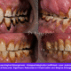 Plasma Cell Gingivitis: Causes, Symptoms, Diagnosis, and Advanced Diode Laser Treatment at Nova Dental Hospital, Gandhinagar