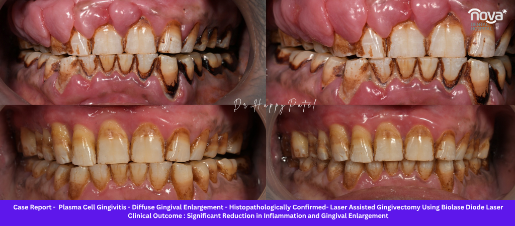 Plasma Cell Gingivitis: Causes, Symptoms, Diagnosis, and Advanced Diode Laser Treatment at Nova Dental Hospital, Gandhinagar