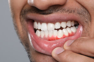 Bleeding Gums: Why It Is Never Normal and What It Is Telling You