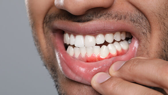 Bleeding Gums: Why It Is Never Normal and What It Is Telling You