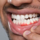 Bleeding Gums: Why It Is Never Normal and What It Is Telling You