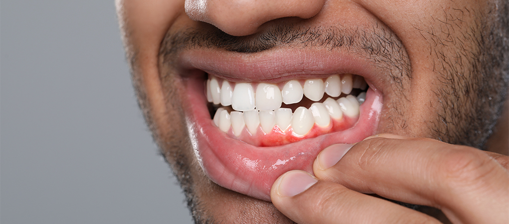 Bleeding Gums: Why It Is Never Normal and What It Is Telling You